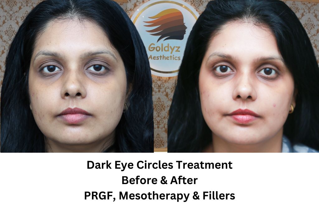 Before and After Treatment of Dark Circles around Eye