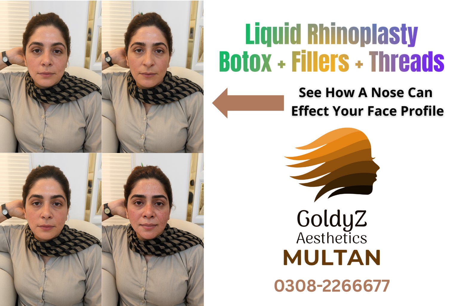 Threads, Fillers and Botox For Liquid Nose Job Rhinoplasty