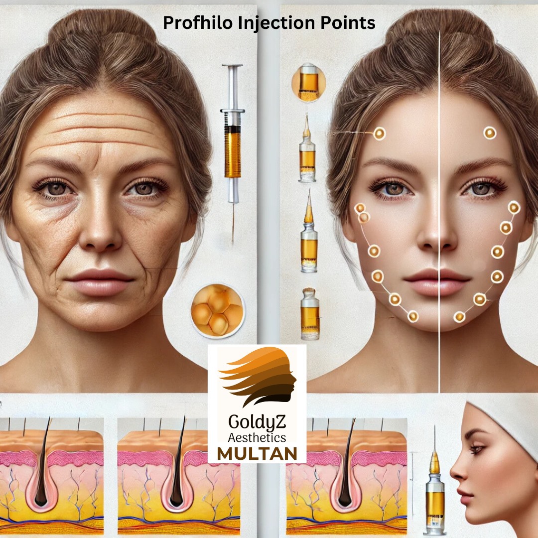 Injection Points for Profhilo